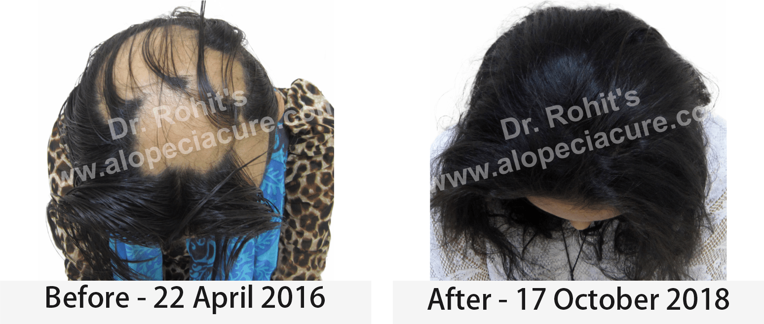 hair loss treatment